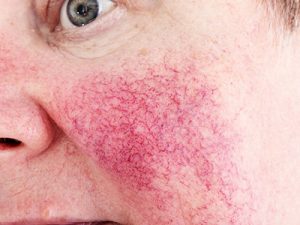 Rosacea